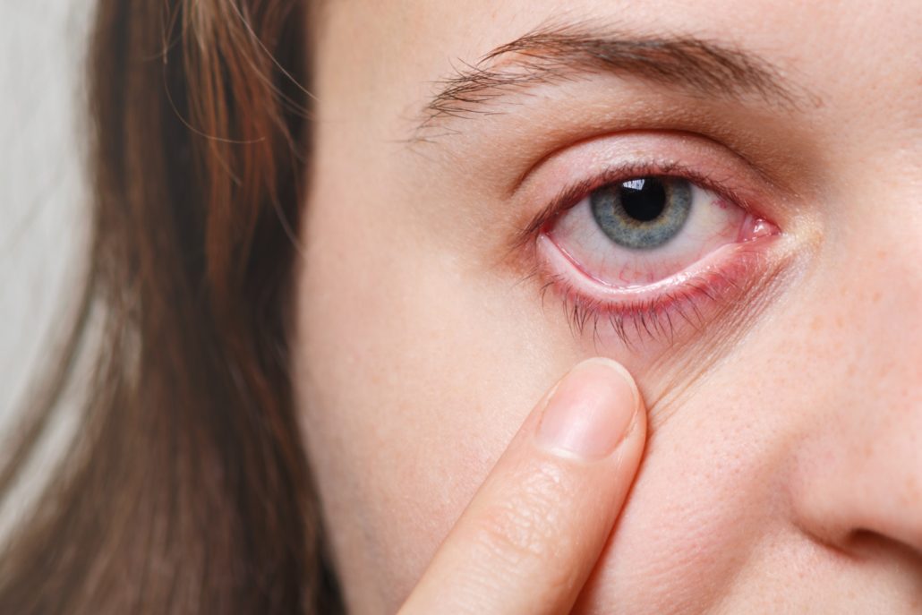 Dry Eye – Simple Guide for Everyone