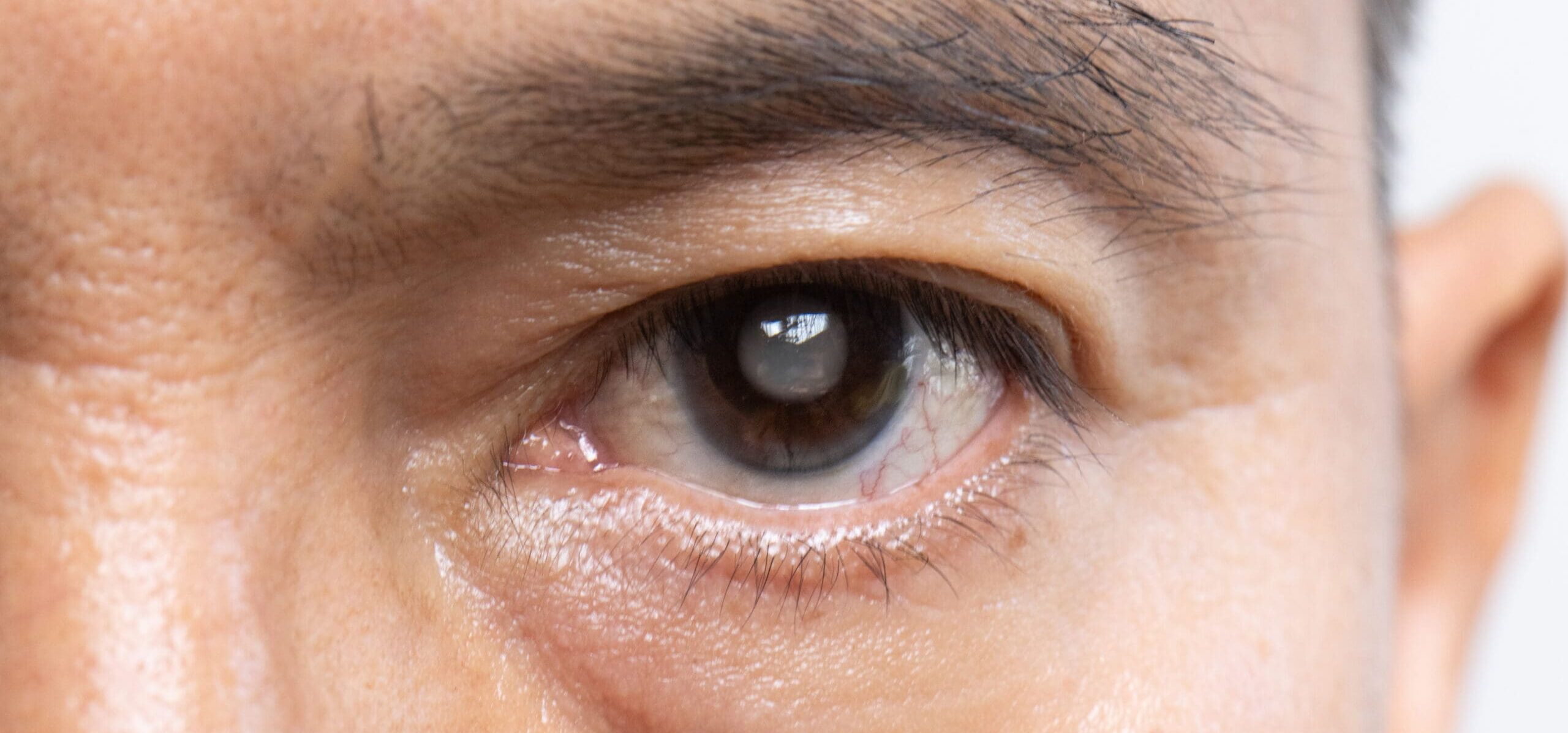 Glaucoma: The Silent Thief of Sight – Why Early Eye Checkups Can Save Your Vision